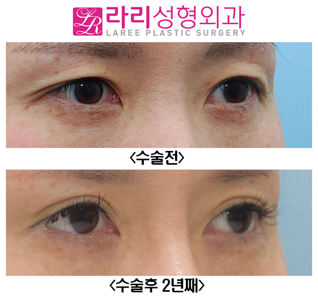 [라리성형외과] 아웃라인 쌍꺼풀재수술 화려하게 변화주기 관련 이미지 4
