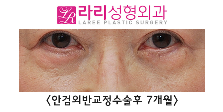 [라리성형외과] 노화로 나타나는 노인성 안검외반의 교정 관련 이미지 6