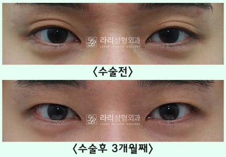 [Lari Plastic Surgery] Removing a Visible Double Eyelid (Double Eyelid Reversal Surgery), From Natural Double Eyelids to Surgical Double Eyelids: A to Z image 15