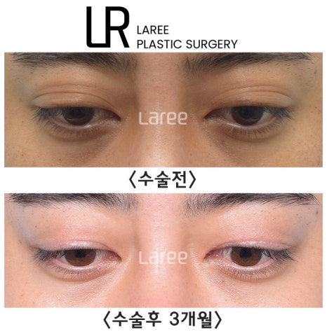 [라리성형외과] 쌍꺼풀없애는 무쌍 수술, 쌍꺼풀라인 낮추기가 아닙니다. (완전무쌍과 무쌍속쌍 그 차이) 관련 이미지 12