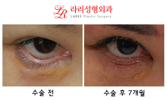 하안검 외상 trauma 또는 수술 surgery 후 안검외반 ectropion 문제해결! 관련 이미지 1