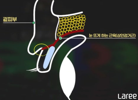 [라리성형외과] 쌍꺼풀수술 후 쌍꺼풀이 풀리는 이유 관련 이미지 2