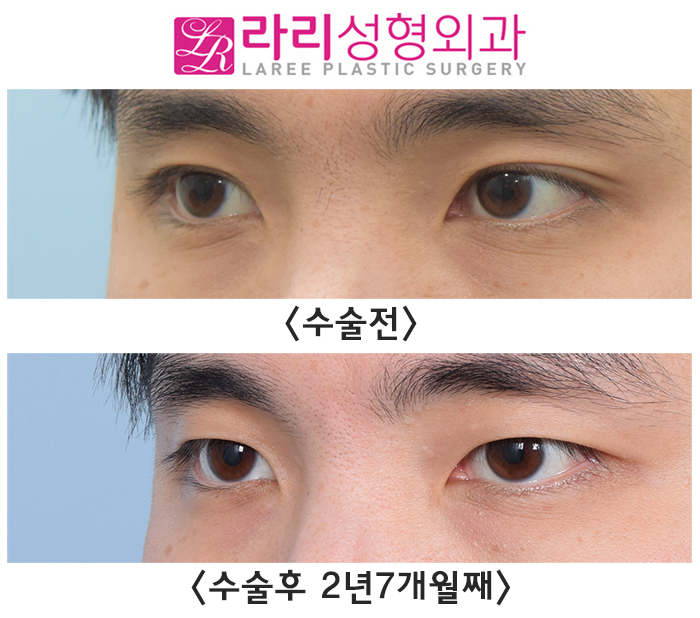 [Lari Plastic Surgery] Long-Term Before-and-After Photos of Surgery to Remove Double Eyelids and Create a Natural Single Eyelid Look image 1