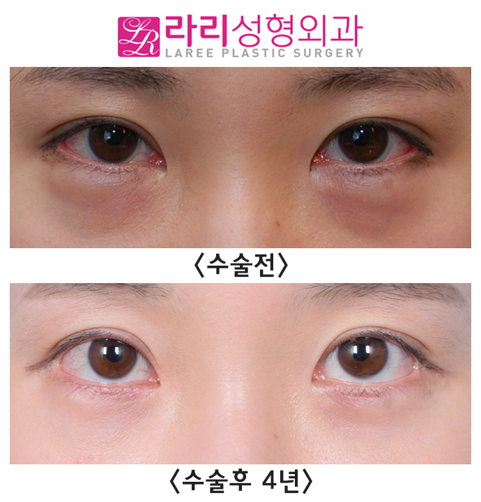 [라리성형외과] 뒤트임 부작용? 빨간살(결막노출) -재수술로 교정 관련 이미지 1