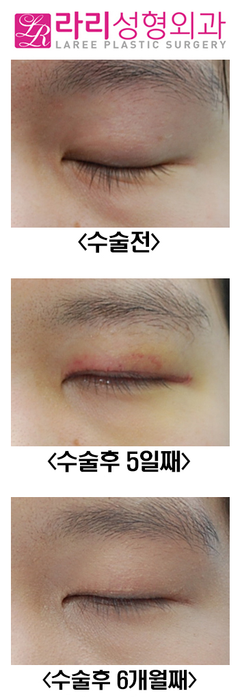[Rari Plastic Surgery] Thick Natural Double Eyelid Removal Surgery: Before and Up to 6 Months After image 3