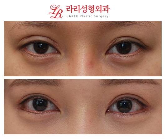 Revision Double Eyelid Surgery, Downward Outer Corner Epicanthoplasty Before and After Photos image 1
