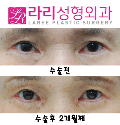 눈앞쪽 여러겹 쌍거풀없애기+뾰족한누호 둥글게 만들기 관련 이미지 1