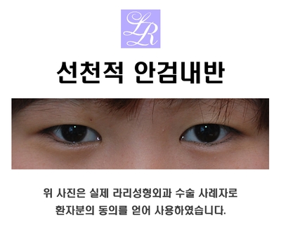 안검내반의 주증상은 속눈썹 찔림 - 수술 교정 관련 이미지 2