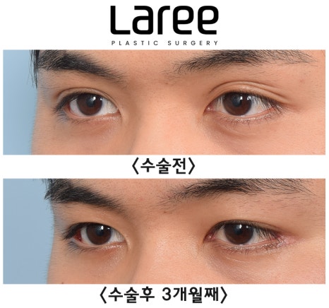 [Lari Plastic Surgery] A Collection of Various Surgeries for Double Eyelids image 8