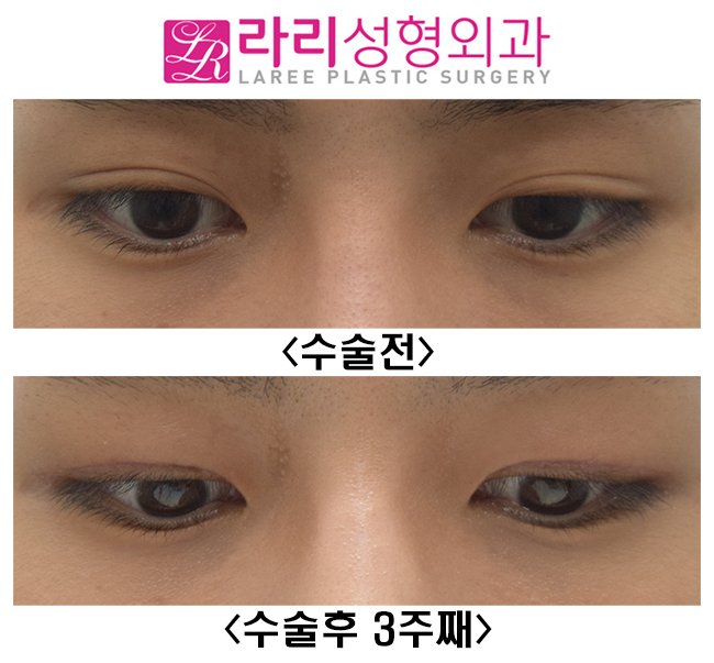 [라리성형외과] 인아웃라인 자연쌍꺼풀을 무쌍속쌍으로 만들기 관련 이미지 4