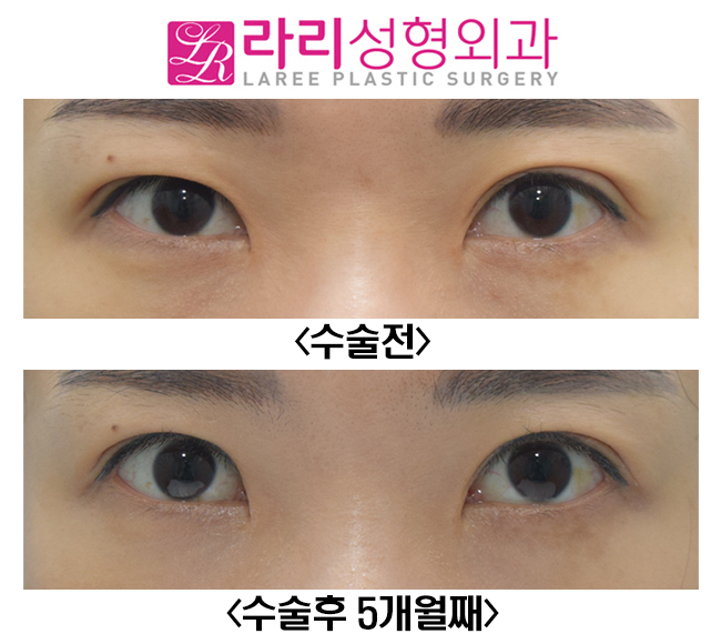 [라리성형외과] 눈매교정이 함께 필요한 쌍꺼풀재수술, 비대칭 눈교정 전후사진 관련 이미지 2