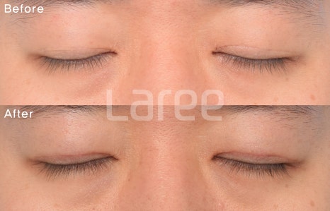 [Lari Plastic Surgery] Everything About Double Eyelid Removal Surgery image 5