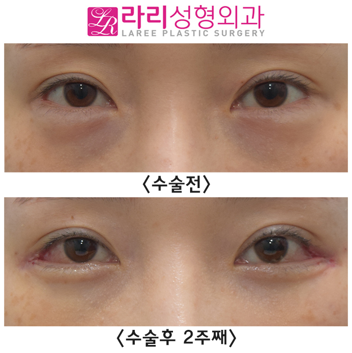 [라리성형외과] 뒤트임재수술 실밥 제거 당일 수술후 2주째 단기 경과 전후 사진 관련 이미지 3