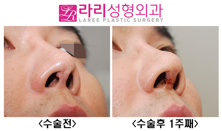 [라리성형외과] 코재수술 : 미용 목적만이 아닌 경우, 복원과 재건 관련 이미지 3