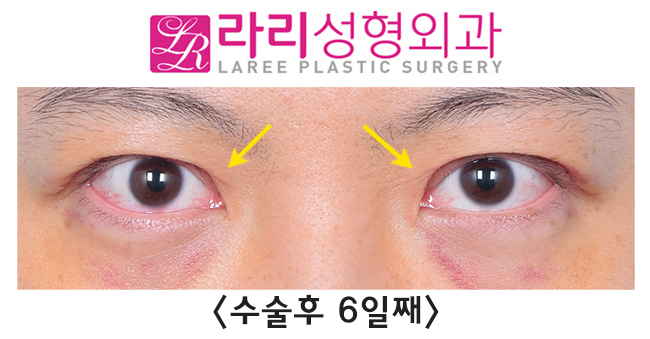 [Rari Plastic Surgery] Recovery Process for Line Irregularity During the Course of Double Eyelid Removal Surgery image 3