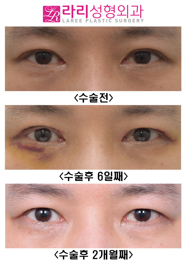 [라리성형외과] 쌍꺼풀없애기 수술 후 짝짝이, 괜찮아질까? 관련 이미지 1