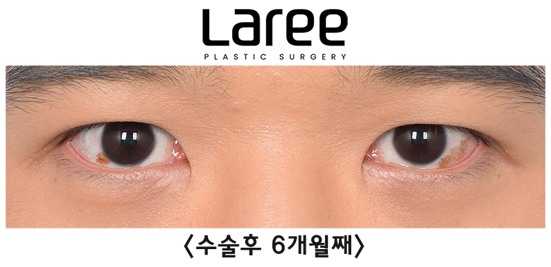 [Lari Plastic Surgery] Eyelid Correction Surgery and Upper Canthoplasty: Experiencing the Maximum Effect of Non-Double-Eyelid Eyelid Correction Without Medial Drooping image 6