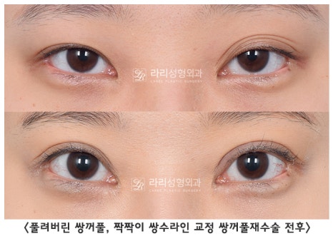 [라리성형외과] 쌍꺼풀수술 그리고 쌍꺼풀재수술 , 성공하려면 어디서 해야 할까요 !? 관련 이미지 9
