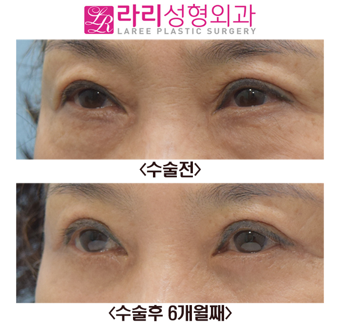 [라리성형외과] 상안검수술과 하안검수술 전후 사진 관련 이미지 4