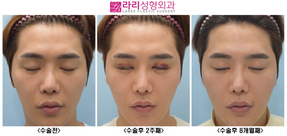 [라리성형외과] 여러겹 두꺼운 자연 쌍꺼풀 무쌍으로 풀기, 없애는 수술 관련 이미지 4
