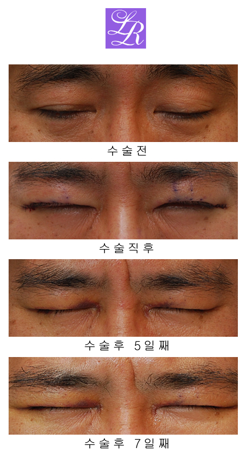 Are you curious about the recovery after double eyelid correction surgery for double eyelid side effects ...? image 4