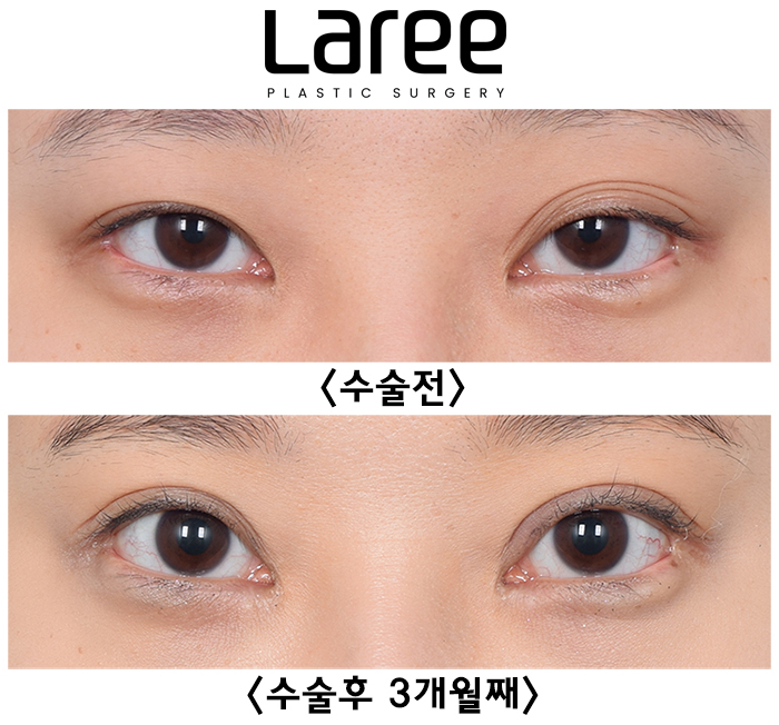 [Laree Plastic Surgery] One-Sided Release After Buried Double Eyelid Surgery, Multiple-Fold Double Eyelid Revision Surgery and Changes After Eyelid Correction image 2