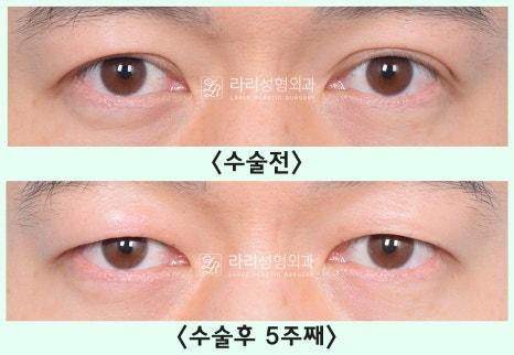[Lari Plastic Surgery] Removing a Visible Double Eyelid (Double Eyelid Reversal Surgery), From Natural Double Eyelids to Surgical Double Eyelids: A to Z image 19