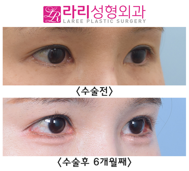 [라리성형외과] 효과 못 본 트임수술, 제대로 터주는 재수술로 유명한 이유가 있습니다. 관련 이미지 3