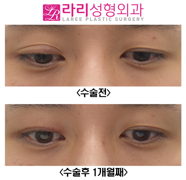 [라리성형외과] 짝눈교정 한쪽눈 재수술 , 한쪽 쌍수 수술후 한달째 관련 이미지 2