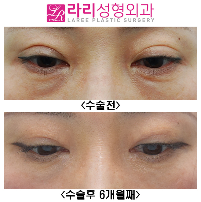 [라리성형외과] 쌍꺼풀재수술, 앞트임재수술, 눈밑지방재배치재수술 전후사진 관련 이미지 5