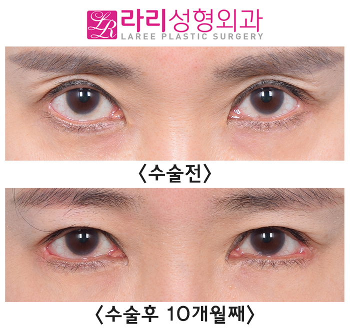 [Lari Plastic Surgery] Sunken Upper Eyelids -> Loop Fat Grafting -> Before-and-After Sunken-Eye Correction Photos image 2