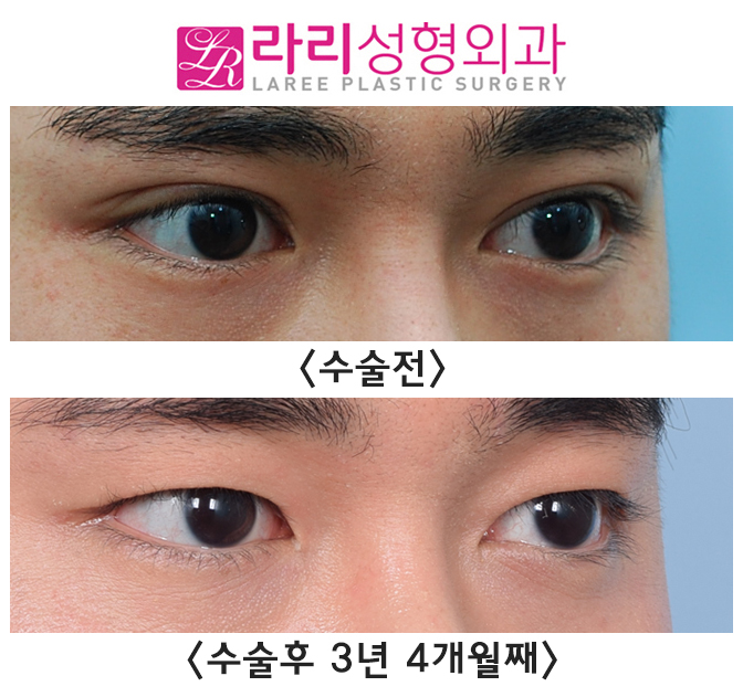[라리성형외과] 매몰 쌍수, 쌍꺼풀 없애는 수술 장기 경과 전후 사진 그리고 실제  동영상 관련 이미지 5