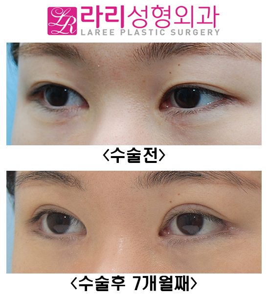 [라리성형외과] 쌍꺼풀재수술, 앞트임복원, 뒤트임재수술, 눈밑지방재배치재수술 전후 관련 이미지 6