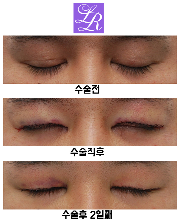 Review of Double Eyelid Reversal Surgery - Day 2 After Surgery, Swelling After Double Eyelid Surgery image 4