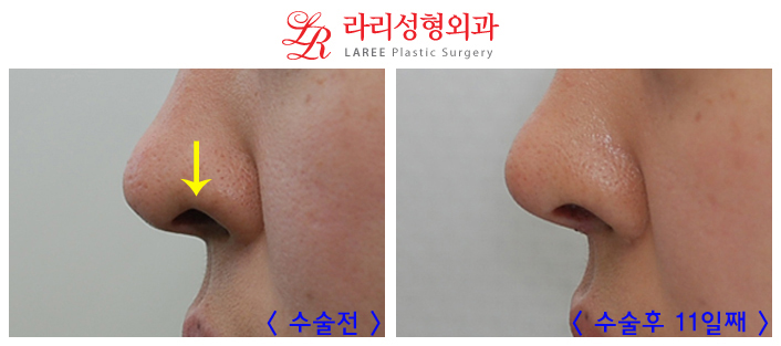 코재수술 잘하는곳 변화가 확실한 라리성형외과! 관련 이미지 8