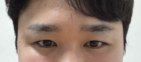 [라리성형외과] 무절제 겉쌍꺼풀없애기 무쌍수술 전후 (+절개와 절제의 차이) 관련 이미지 8