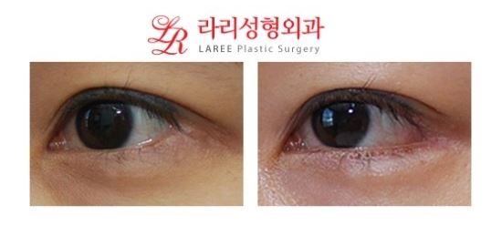 뒤트임/뒤트임재수술/뒷트임재수술 전후사진 관련 이미지 2