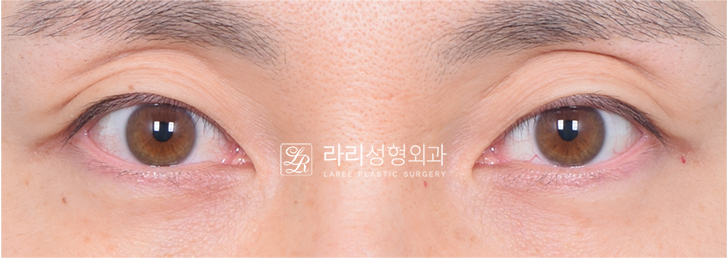 [라리성형외과] 아이홀 꺼짐 있는 눈 파악하고, 윗눈꺼풀 지방이식으로 교정 관련 이미지 7