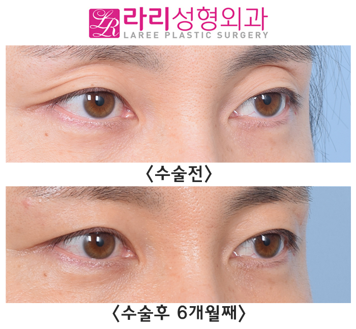 [라리성형외과] 절개쌍꺼풀없애기 + 윗눈꺼풀지방이식, 6개월 차 수술 전후 경과 사진 관련 이미지 3