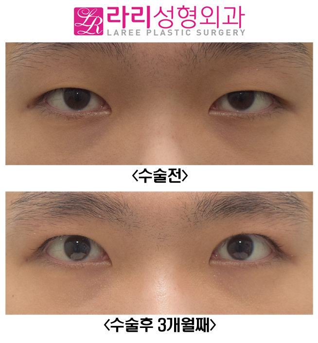 [라리성형외과] 남자 절개눈매교정 무쌍눈매교정 관련 이미지 2