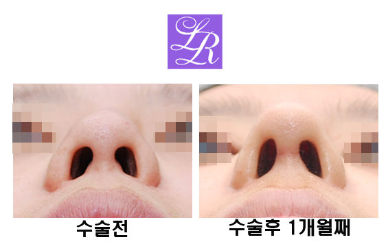코재수술 코끝을 오똑하게 관련 이미지 6