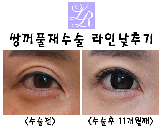쌍꺼풀재수술 왜 필요한거죠? 라인교정, 붓기, 경과, 흉터교정 관련 이미지 2