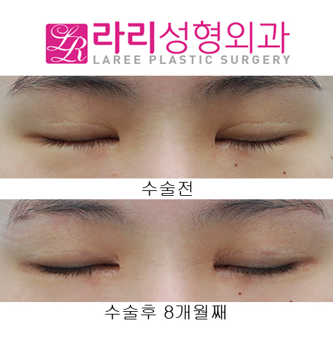 [라리성형외과] 쌍꺼풀재수술 소세지교정, 뒤트임재수술 관련 이미지 2
