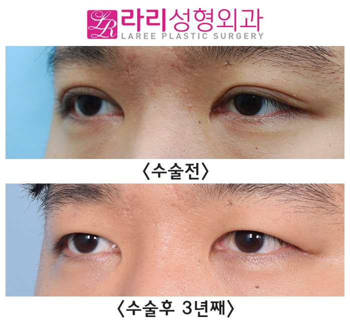 [Rari Plastic Surgery] Causes of Uneven Eye Size After Double Eyelid Removal Surgery, Cases That Naturally Even Out, Before-and-After Photos image 2