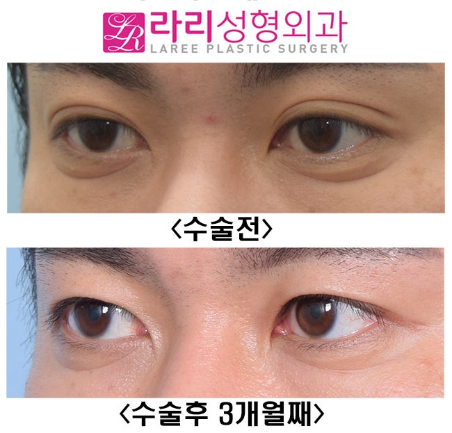 [라리성형외과] 원래 없었던 것처럼 보이는 자연쌍꺼풀없애기 관련 이미지 5