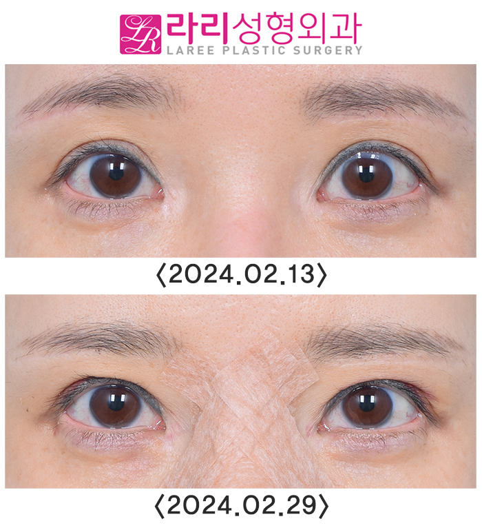 [라리성형외과] 이마보톡스가 눈 모양이나 쌍꺼풀 라인에 미치는 영향에 대하여 관련 이미지 5