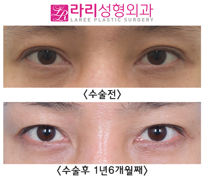 [라리성형외과] 쌍꺼풀없애기 ? 쌍꺼풀라인낮추기 ? 고민이 된다면 관련 이미지 1