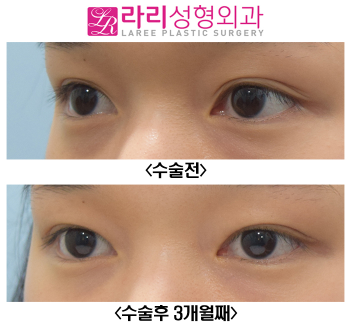 [Lari Plastic Surgery] Reducing the Double Eyelid Line from an Outline to an Inline for a Natural Look image 2