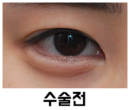 Swelling and Results Judged from Photos in Non-Incision Eye Correction Reviews image 1