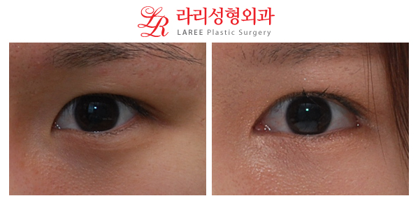 ☆Wangnuni Plastic Surgery☆ Before-and-after photos of epicanthoplasty and lateral canthoplasty with lowering of the outer eye corner: long-term follow-up of over 2 years! image 1